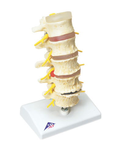 3B Scientific Anatomical Model - vertebrae degeneration, stages of prolapsed disc - Includes 3B Smart Anatomy