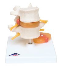 3B Scientific Anatomical Model - Lumbar Spinal Column with Prolapsed Intervertebral Disc - Includes 3B Smart Anatomy