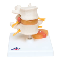 3B Scientific Anatomical Model - Lumbar Spinal Column with Prolapsed Intervertebral Disc - Includes 3B Smart Anatomy