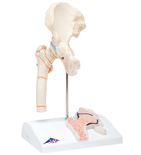 3B Scientific Anatomical Model - Femoral Fracture and Hip Osteoarthritis - Includes 3B Smart Anatomy