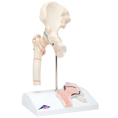 3B Scientific Anatomical Model - Femoral Fracture and Hip Osteoarthritis - Includes 3B Smart Anatomy