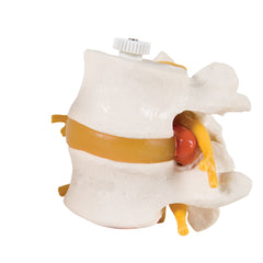 3B Scientific Anatomical Model - 2 Lumbar Vertebrae with prolapsed disc, flexibly mounted - Includes 3B Smart Anatomy