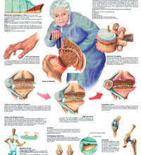 Anatomical Chart - arthritis, laminated