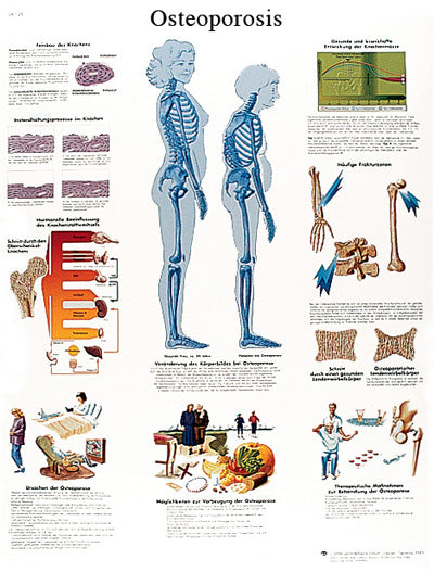 Anatomical Chart - osteoporosis, laminated