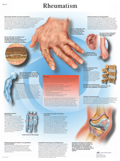 Anatomical Chart - rheumatic diseases, laminated