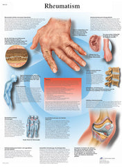 Anatomical Chart - rheumatic diseases, paper