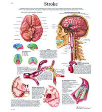 Anatomical Chart - stroke chart, laminated