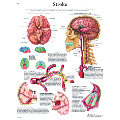 Anatomical Chart - stroke chart, laminated