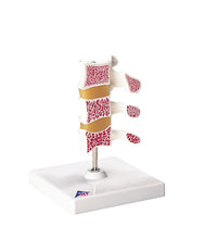 3B Scientific Anatomical Model - Deluxe Osteoporosis Model (3 Vertebrae) - Includes 3B Smart Anatomy