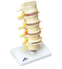 3B Scientific Anatomical Model - vertebrae degeneration, stages of prolapsed disc - Includes 3B Smart Anatomy