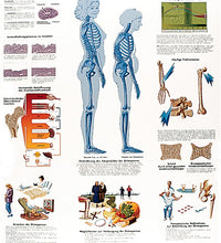 Anatomical Chart - osteoporosis, laminated