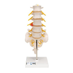 Human Lumbar Spinal Column Model with Dorso-Lateral Prolapsed Intervertebral Disc - 3B Smart Anatomy