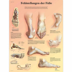 Fehlstellungen der Füße
