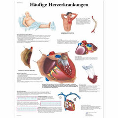 Häufige Herzerkrankungen