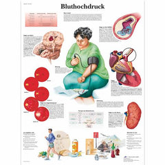 Bluthochdruck