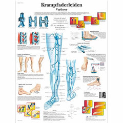 Krampfaderleiden, Varikose