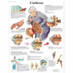 L'arthrose