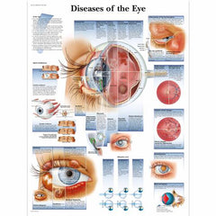 Diseases of the Eye Chart