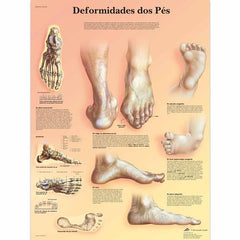 Deformidades dos Pés
