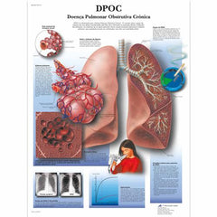 Doença pulmonar obstrutiva crônica, 50x67 cm, Versao Papel