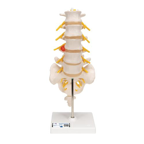 Human Lumbar Spinal Column Model with Dorso-Lateral Prolapsed Intervertebral Disc - 3B Smart Anatomy