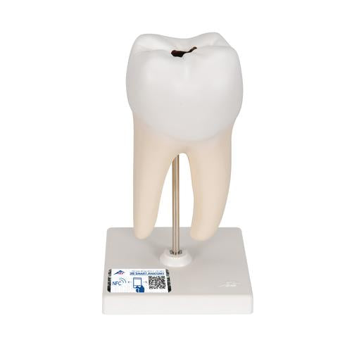 Lower Twin-Root Molar with Cavities Human Tooth Model, 2 part - 3B Smart Anatomy