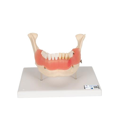 Dental Disease Model, Magnified 2 times, 21 parts - 3B Smart Anatomy