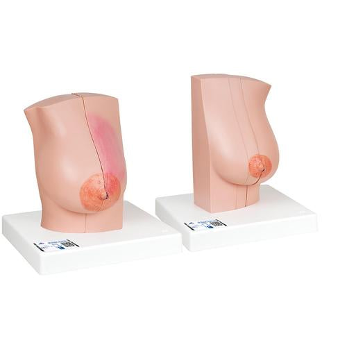 Model of Female Breast with Healthy & Unhealthy Tissue - 3B Smart Anatomy