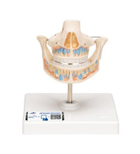 Milk Denture Model with Remaining Teeth - 3B Smart Anatomy