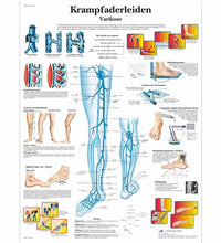 Krampfaderleiden, Varikose