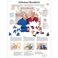 Alzheimer-Krankheit