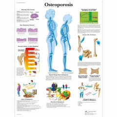 Osteoporosis Chart