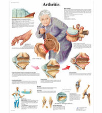 Arthritis Chart