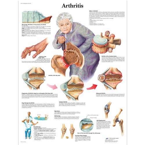 Arthritis Chart