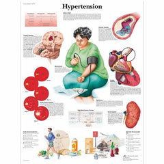 Hypertension Chart