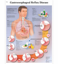 Gastroesophageal Reflux Disease Chart (GERD)
