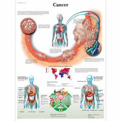 Cancer Chart