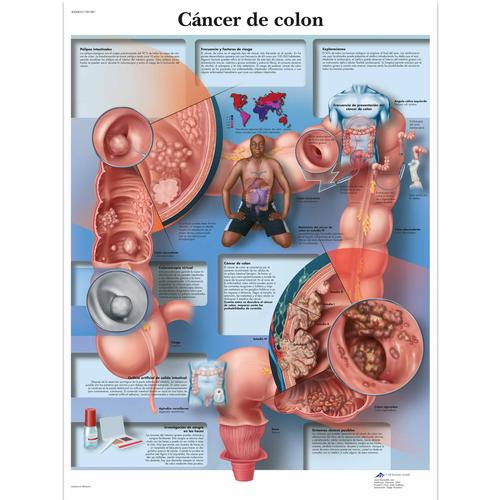 Cáncer de colon