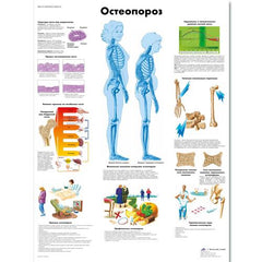 Osteoporosis Chart