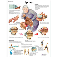 Arthritis Chart