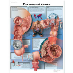 Colon Cancer Chart