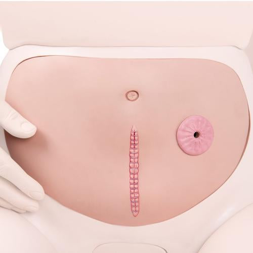 Abdominal Wall with Staple Suture