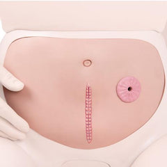 Abdominal Wall with Staple Suture