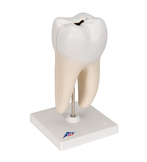 Lower Twin-Root Molar with Cavities Human Tooth Model, 2 part - 3B Smart Anatomy