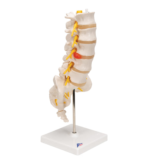 Human Lumbar Spinal Column Model with Dorso-Lateral Prolapsed Intervertebral Disc - 3B Smart Anatomy