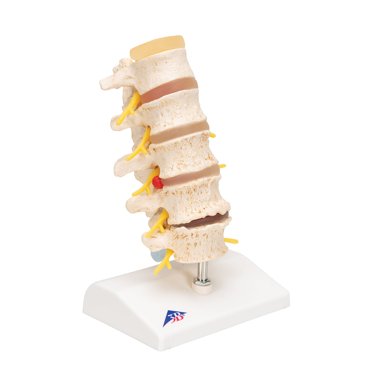 Stages of Disc Prolapse and Vertebral Degeneration - 3B Smart Anatomy