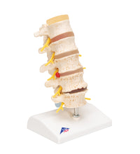 Stages of Disc Prolapse and Vertebral Degeneration - 3B Smart Anatomy