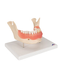 Dental Disease Model, Magnified 2 times, 21 parts - 3B Smart Anatomy