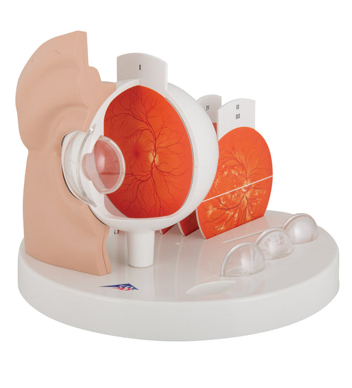 Pathological Human Eye Model - 3B Smart Anatomy