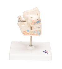 Milk Denture Model with Remaining Teeth - 3B Smart Anatomy